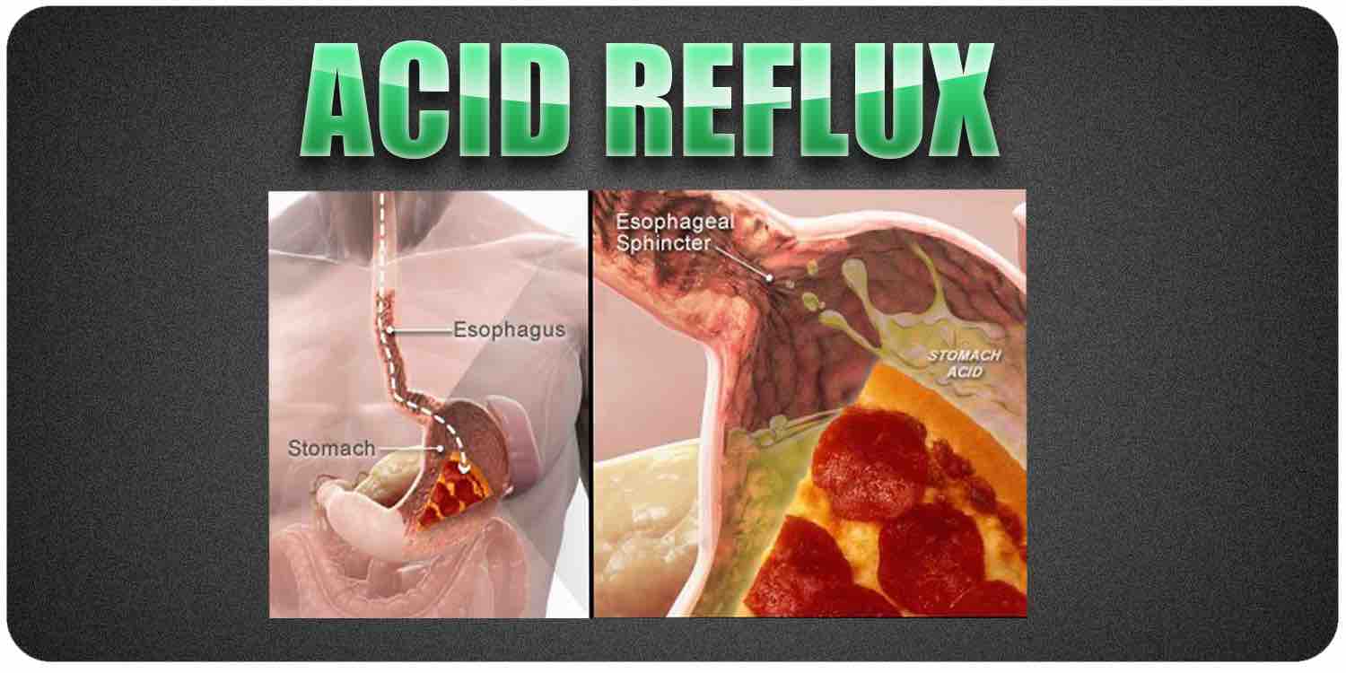 Acid reflux